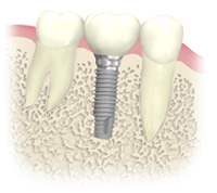 インプラントとは