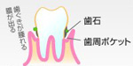 第1段階（歯周炎第1～2度）