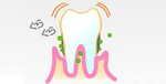 第2段階（歯周炎第3～4度）